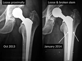 Oct 2013 January 2014
Loose proximally Loose & broken stem
 