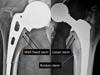 Well fixed stem Loose stem
Broken stem
 