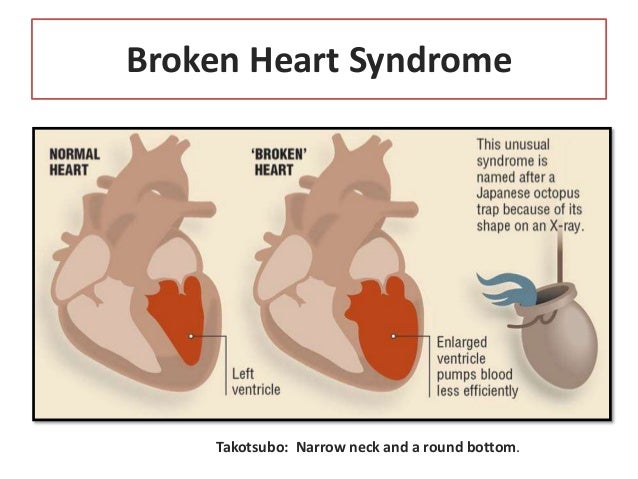 broken-heart-syndrome