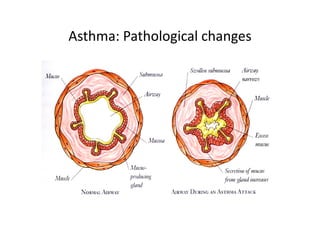 Asthma: Pathological changes
 