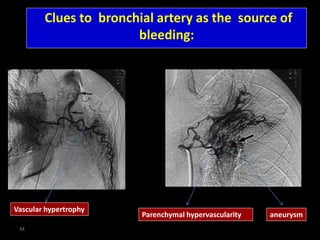 Clues to bronchial artery as the source of
bleeding:
34
Parenchymal hypervascularity
Vascular hypertrophy
aneurysm
 