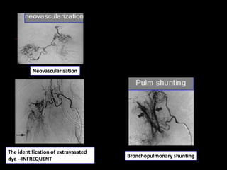 35
The identification of extravasated
dye --INFREQUENT
Bronchopulmonary shunting
Neovascularisation
 