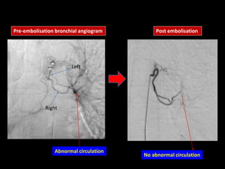 Right
Left
Abnormal circulation
Pre-embolisation bronchial angiogram
No abnormal circulation
Post embolisation
 