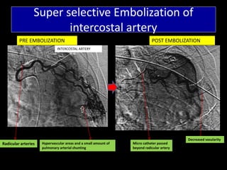 Super selective Embolization of
intercostal artery
Hypervascular areas and a small amount of
pulmonary arterial shunting
Decreased vasularity
POST EMBOLIZATIONPRE EMBOLIZATION
Radicular arteries
INTERCOSTAL ARTERY
Micro catheter passed
beyond radicular artery
 