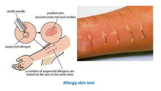 Allergy-skin test
 