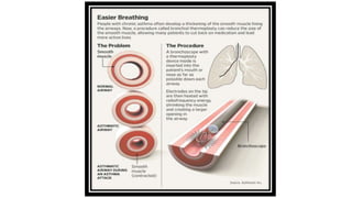 Bronchial Asthma by Dr. Sookun Rajeev Kumar