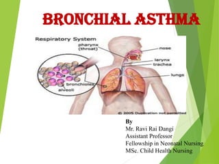 BRONCHIAL ASTHMA
By
Mr. Ravi Rai Dangi
Assistant Professor
Fellowship in Neonatal Nursing
MSc. Child Health Nursing
 