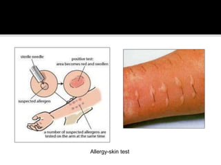 Allergy-skin test
 