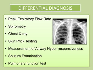 DIFFERENTIAL DIAGNOSIS
• Peak Expiratory Flow Rate
• Spirometry
• Chest X-ray
• Skin Prick Testing
• Measurement of Airway Hyper responsiveness
• Sputum Examination
• Pulmonary function test
 