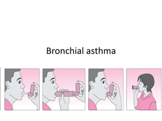 Bronchial asthma
 