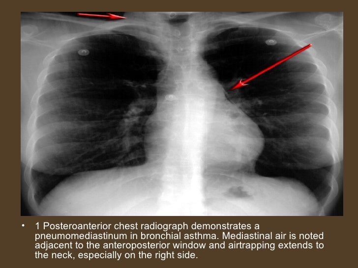 Asthma Chest X Ray