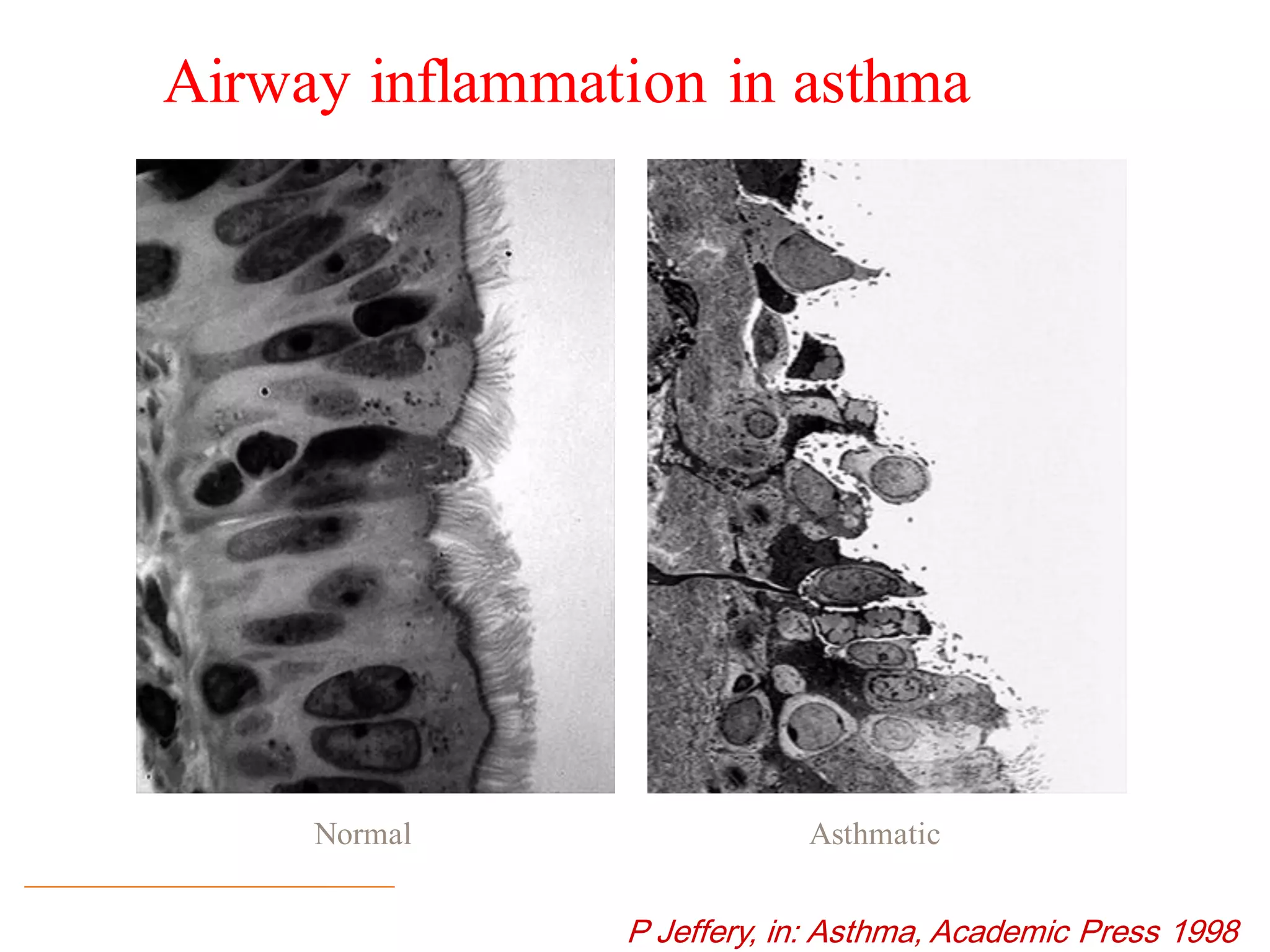 Airway inflammation in asthma
AsthmaticNormal
P Jeffery, in: Asthma, Academic Press 1998
 