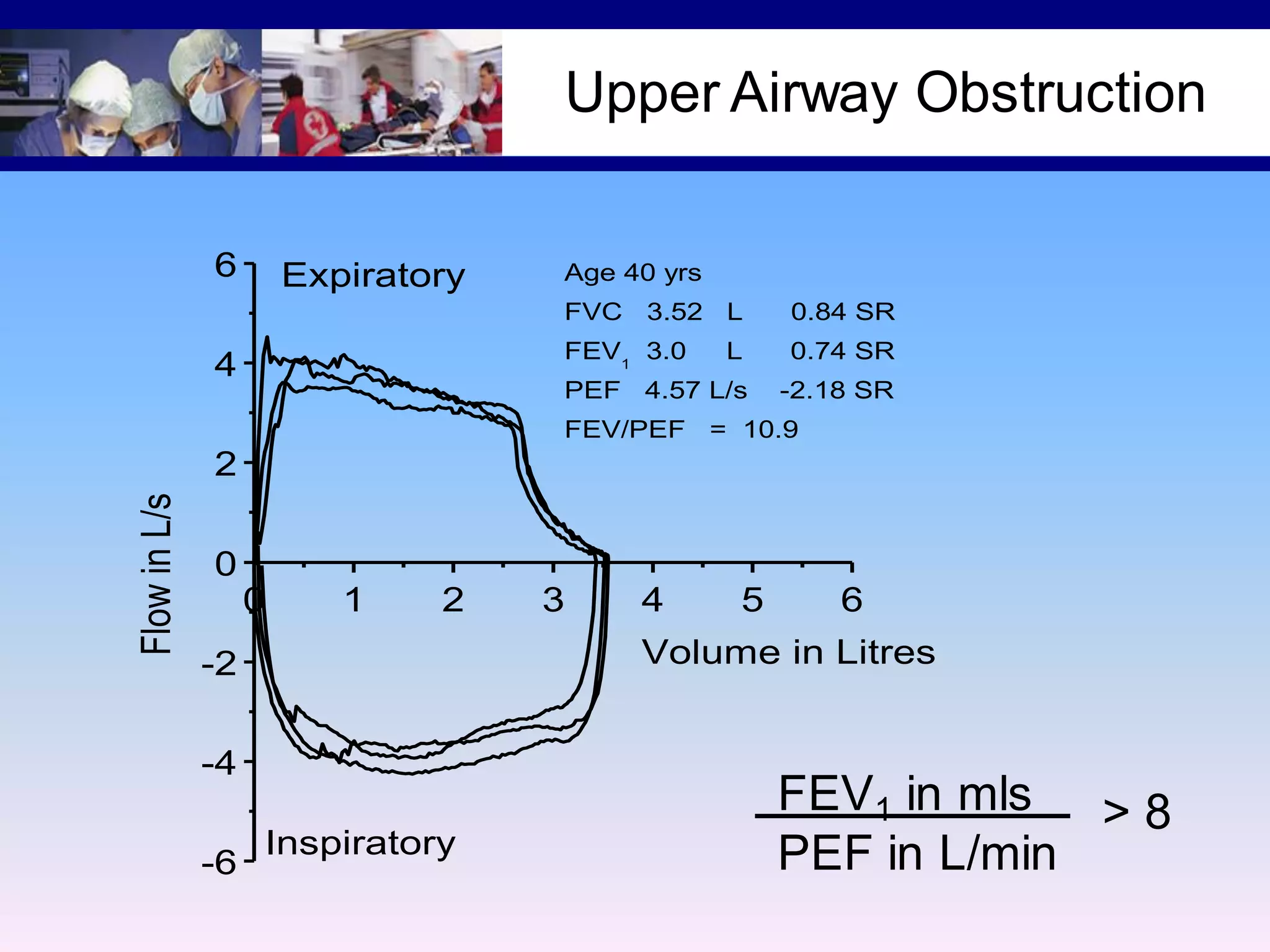 Upper Airway Obstruction
0 1 2 3 4 5 6
-6
-4
-2
0
2
4
6 Age 40 yrs
FVC 3.52 L 0.84 SR
FEV1
3.0 L 0.74 SR
PEF 4.57 L/s -2.18 SR
FEV/PEF = 10.9
Inspiratory
Expiratory
FlowinL/s
Volume in Litres
FEV1 in mls
PEF in L/min
> 8
 