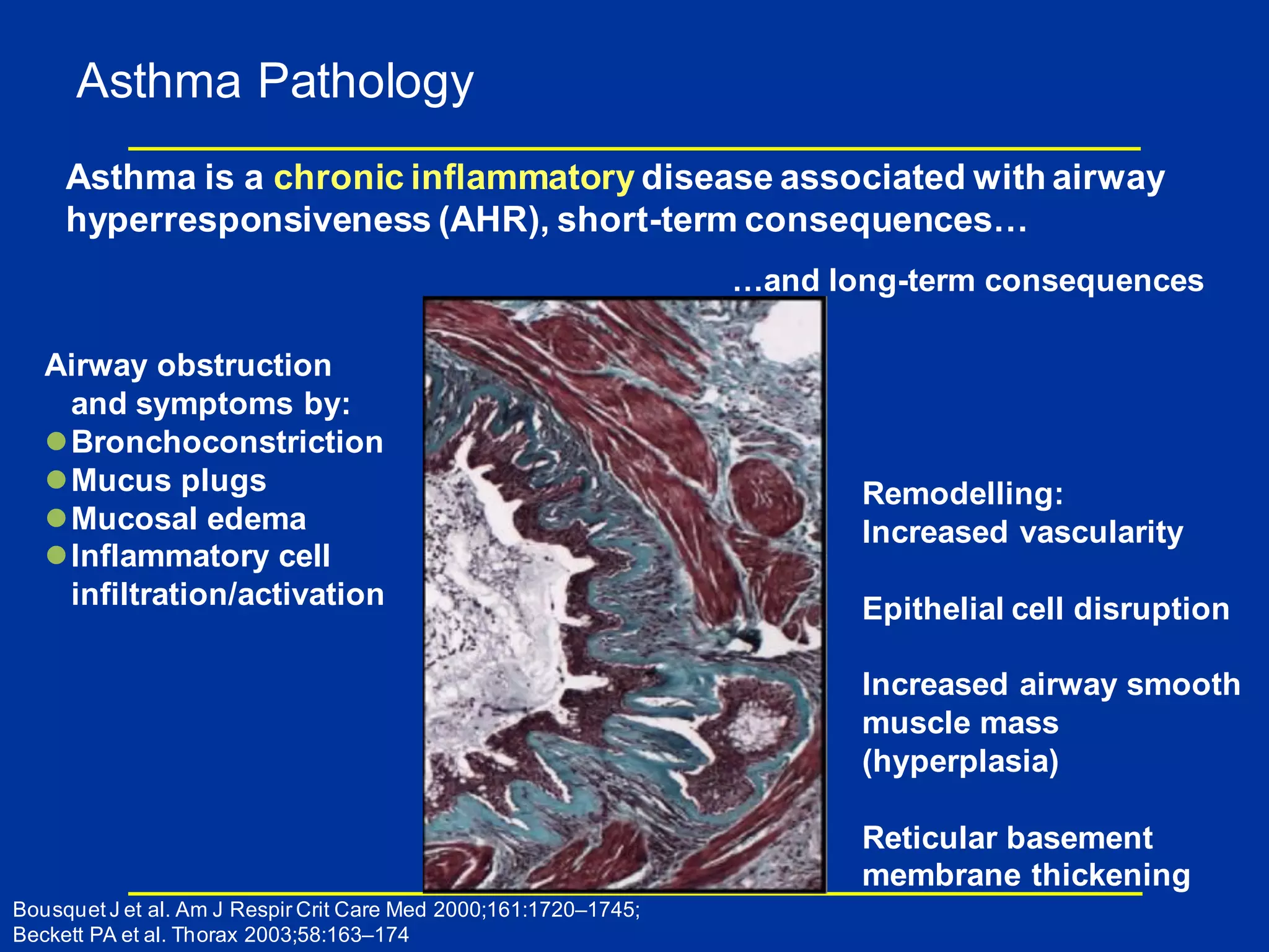 Asthma Pathology
Asthma is a chronic inflammatory disease associated with airway
hyperresponsiveness (AHR), short-term consequences…
Airway obstruction
and symptoms by:
Bronchoconstriction
Mucus plugs
Mucosal edema
Inflammatory cell
infiltration/activation
Remodelling:
Increased vascularity
Epithelial cell disruption
Increased airway smooth
muscle mass
(hyperplasia)
Reticular basement
membrane thickening
…and long-term consequences
Bousquet J et al. Am J Respir Crit Care Med 2000;161:1720–1745;
Beckett PA et al. Thorax 2003;58:163–174
 