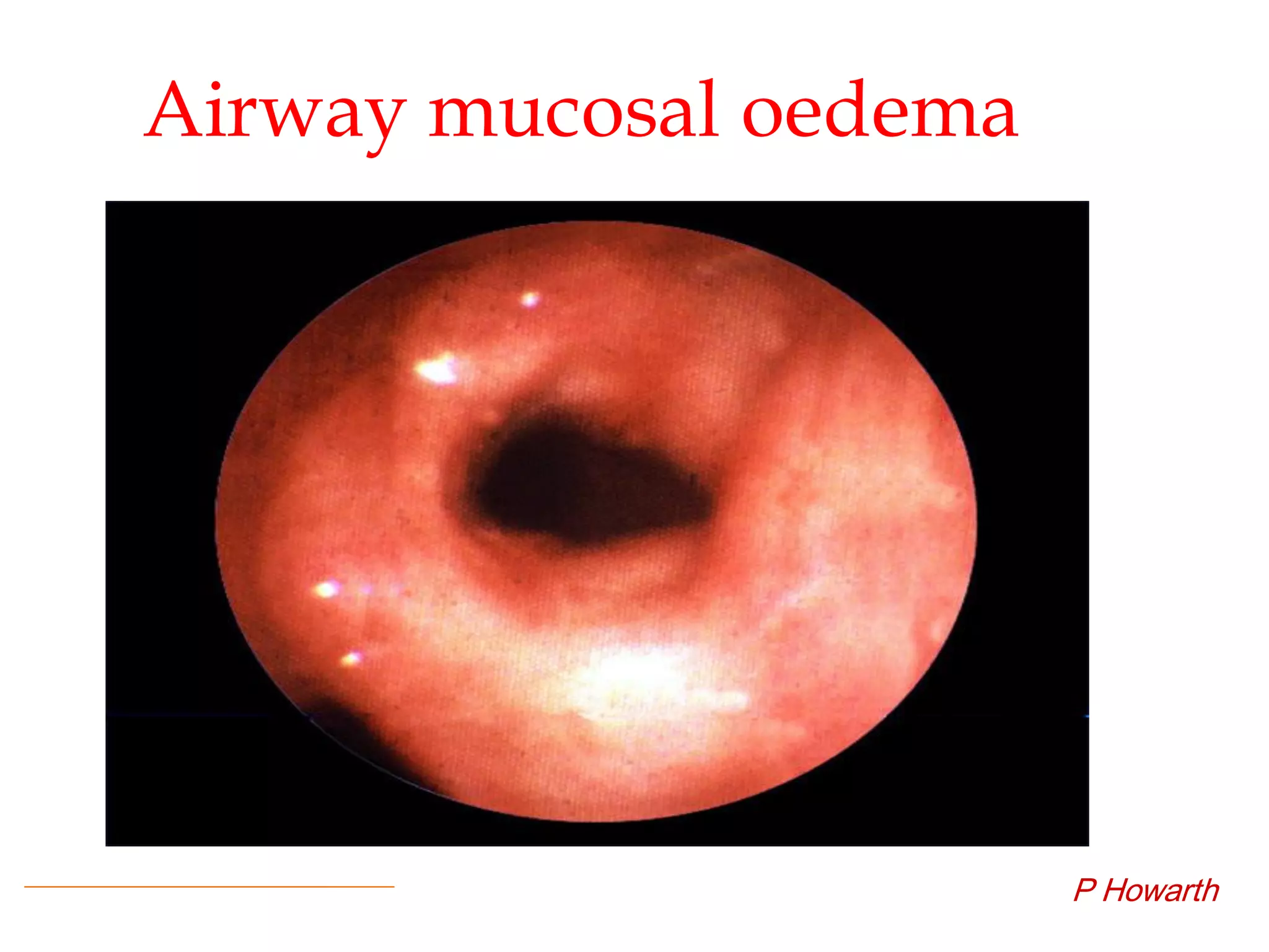 Airway mucosal oedema
P Howarth
 