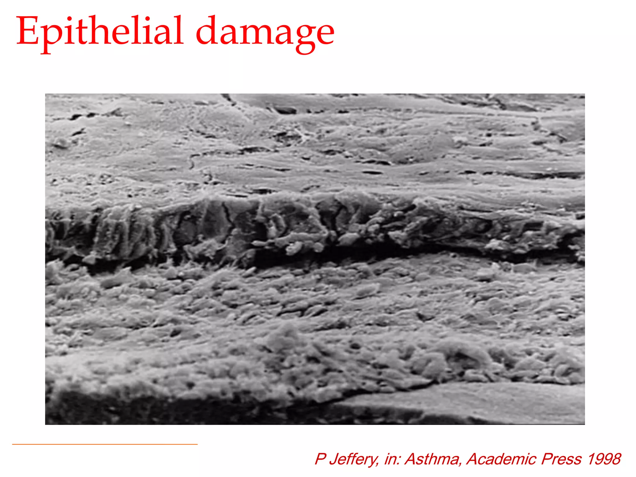 Epithelial damage
P Jeffery, in: Asthma, Academic Press 1998
 