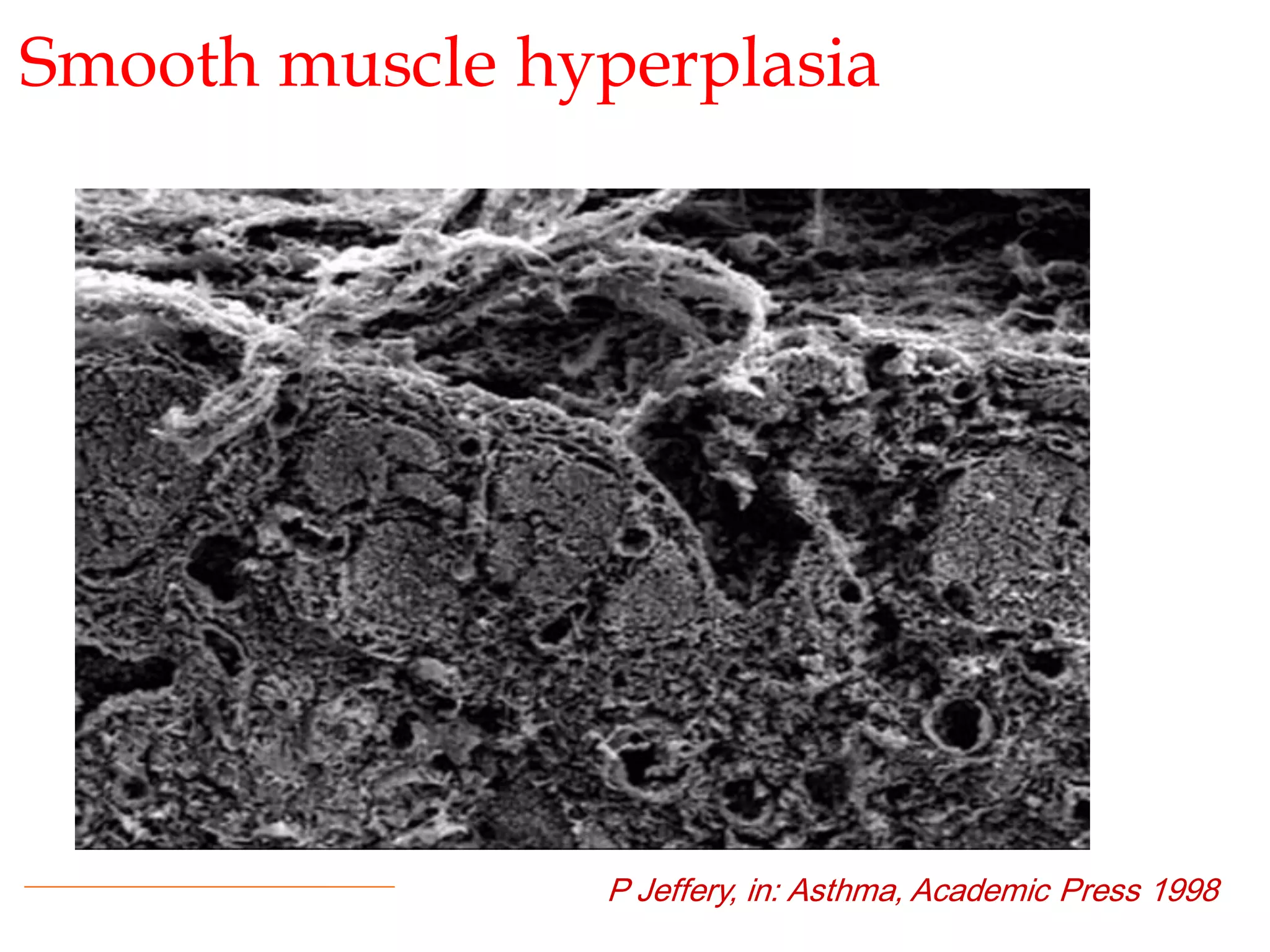 Smooth muscle hyperplasia
P Jeffery, in: Asthma, Academic Press 1998
 