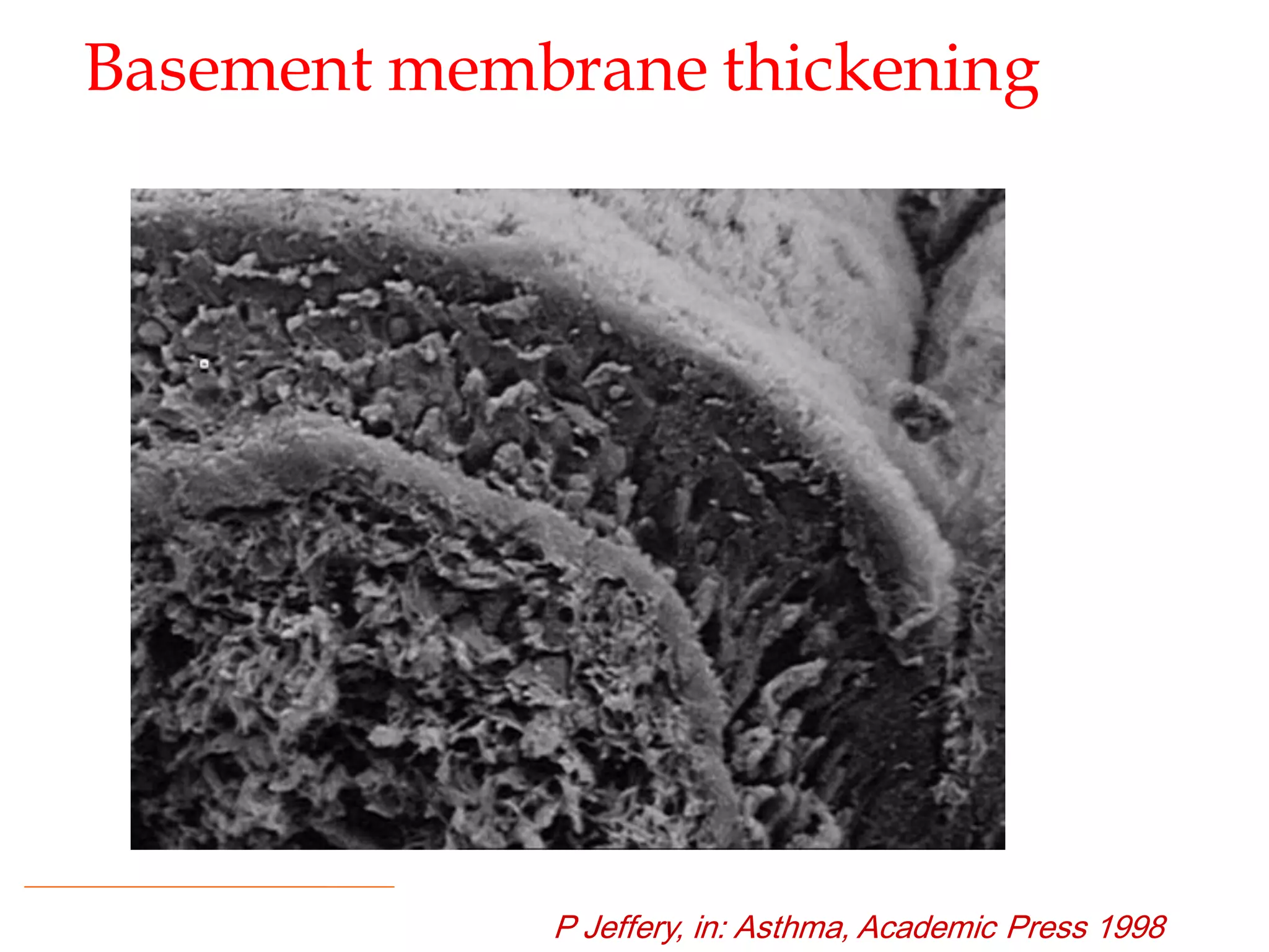 Basement membrane thickening
P Jeffery, in: Asthma, Academic Press 1998
 