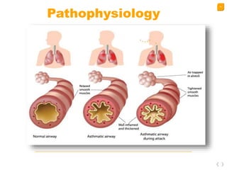 16
Pathophysiology
 