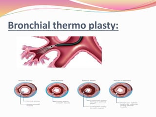 Bronchial thermo plasty:
 