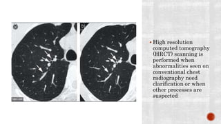  High resolution
computed tomography
(HRCT) scanning is
performed when
abnormalities seen on
conventional chest
radiography need
clarification or when
other processes are
suspected
 
