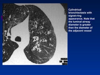 Cylindrical bronchiectasis with signet-ring appearance. Note that the luminal airway diameter is greater than the diameter of the adjacent vessel 
