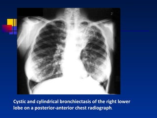 Cystic and cylindrical bronchiectasis of the right lower lobe on a posterior-anterior chest radiograph . 