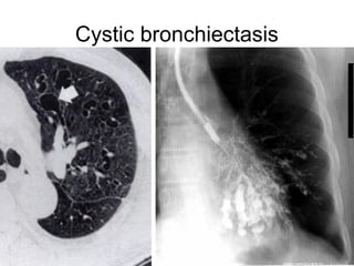 Cystic bronchiectasis
 
