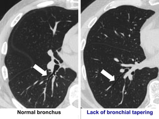 Abnormal bronchial contour
 