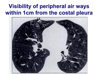 • Peribronchial cuffing (thickened hazy bronchial
wall).
• Finger in glove opacities (mucus filled bronchi).
• Multiple air fluid levels (fluid filled bronchi).
 