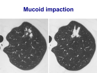 Multiple air fluid levels
 
