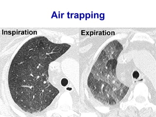 Tree in budd opacities
 