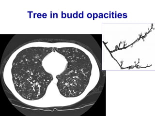 Pseudo-bronchiectasis
• Pitfalls in diagnosis of bronchiectasis.
• Motion artifact (respiratory or cardiac
motion artifact).
 