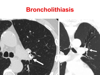 Post-irradiation fibrosis
(traction bronchiectasis)
 