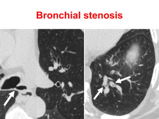 Diffuse bronchiectasis
with central predominance
• ABPA.
• Mounier Kuhn syndrome.
• William Campbell syndrome.
 