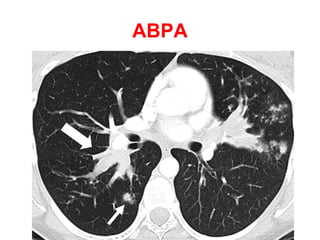 William Campbell syndrome
Congenital cystic bronchiectasis that results from a
deficiency of cartilage in the 4th
to 6th
order bronchi
 