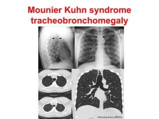 Diffuse bronchiectasis
with upper lobe predominance
• Cystic fibrosis.
• Sarcoidosis.
 