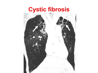 Diffuse bronchiectasis
with middle lobe & lingula predominance
• Non tuberculous mycobacterial infection.
• Immobile cilia syndrome.
 