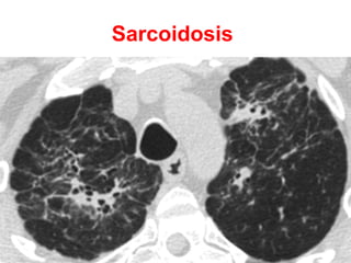 Mycobacterium avium
intercellulare infection
 