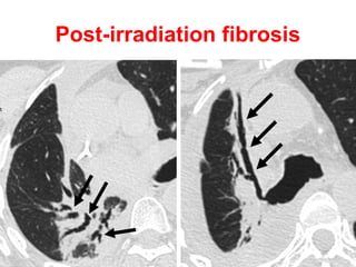 Immotile cilia syndrome
 