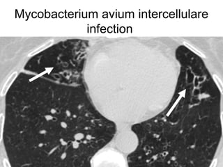 Interstitial lung disease
 
