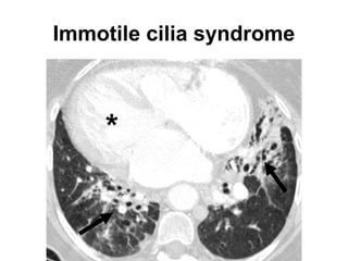 Case
• 65-year-old man with a chronic productive
cough and progressive dyspnea on
exertion.
 