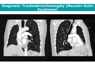 Bronchietasis
Lack of bronchial
tapering
+
Tree in bud
opacities
 