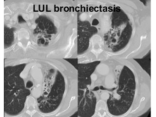 LUL bronchiectasis
 