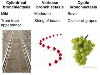 Cylindrical
bronchiectasis
Varicose
bronchiectasis
Cystic
bronchiectasis
Mild Moderate Sever
Tram track
appearance
String of beads Cluster of grapes
 