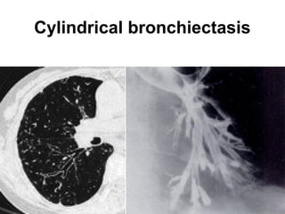 Cylindrical bronchiectasis
 