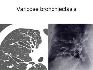 Varicose bronchiectasis
 