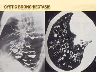 CYSTIC BRONCHIECTASIS
 