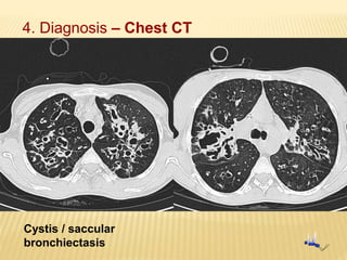 Cystis / saccular
bronchiectasis
4. Diagnosis – Chest CT
 