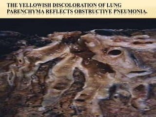 THE YELLOWISH DISCOLORATION OF LUNG
PARENCHYMA REFLECTS OBSTRUCTIVE PNEUMONIA.
 